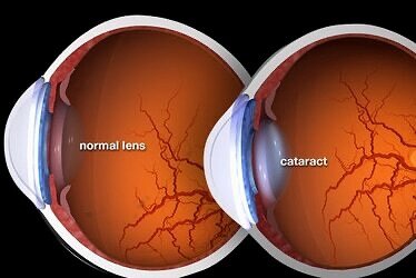 Cataract Surgery