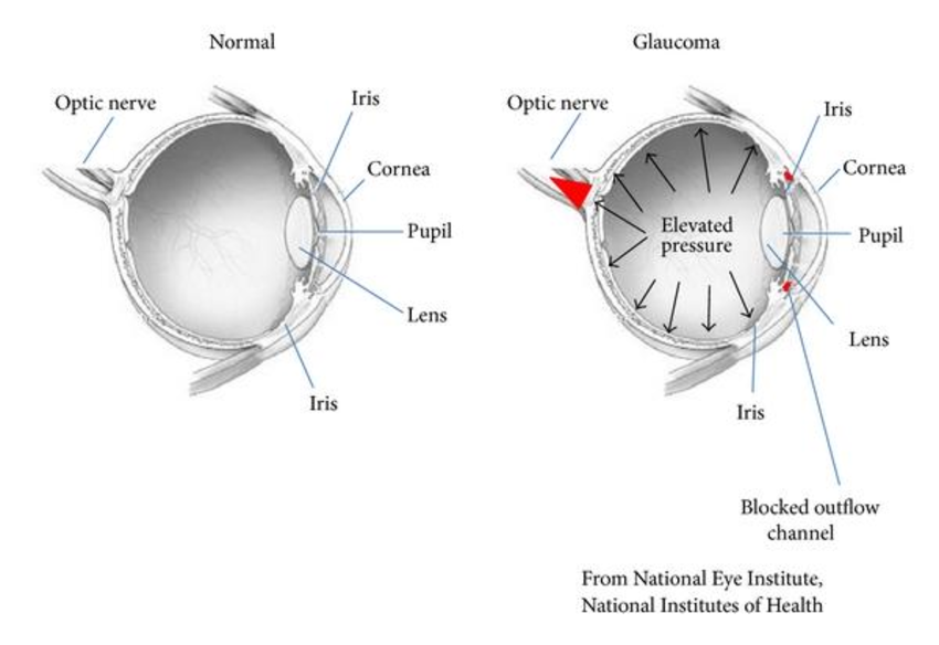 Glaucoma