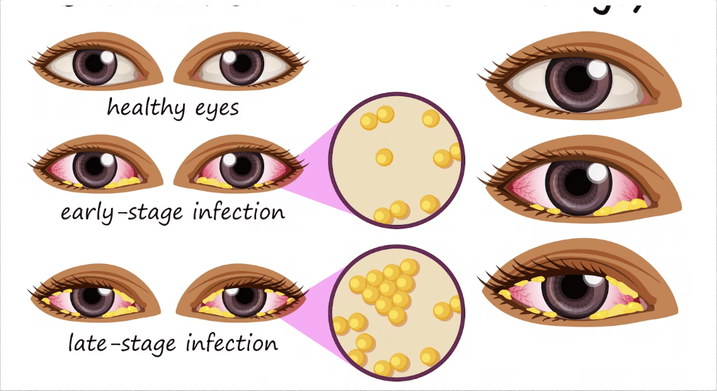Allergy Eye Symptoms - Dr. Luna Xu
